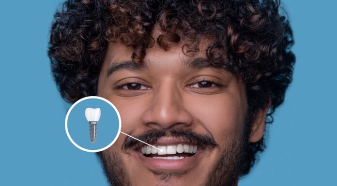 Rozwiązanie mitów o implantach zębowych